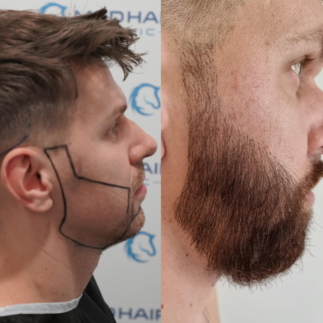 2400 Grafts Barthaartransplantation vorher-nachher – gleichmäßiger Bartwuchs und volle Konturen durch präzise DHI-Methode