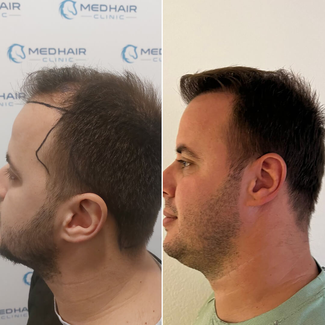 2900 Grafts DHI Haartransplantation vorher-nachher – präzise Verdichtung der Haarlinie mit natürlichem und ästhetischem Ergebnis
