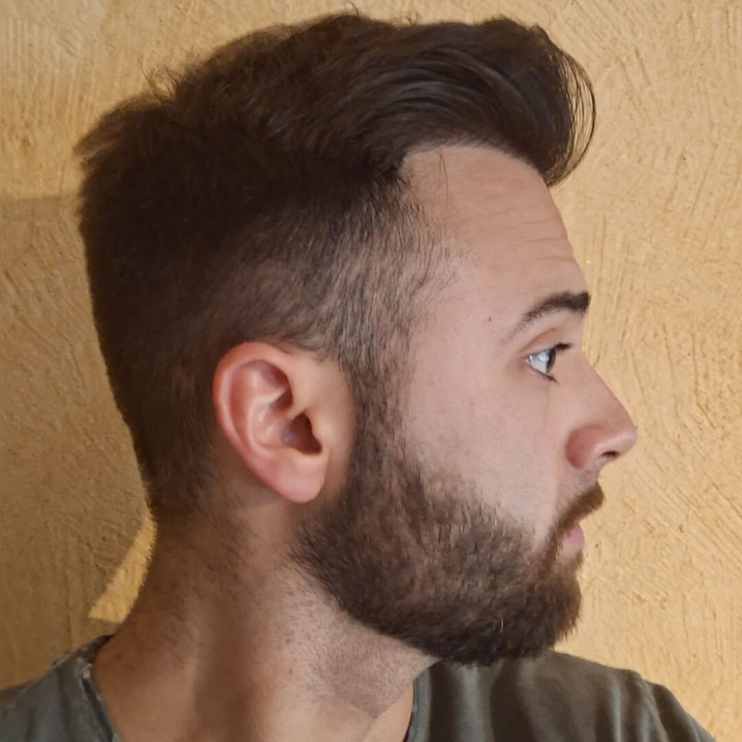 3100 Grafts – Ergebnis der Haartransplantation zeigt verdichteten Haaransatz und natürliches Gesamtbild bei mittelstarkem Haarausfall