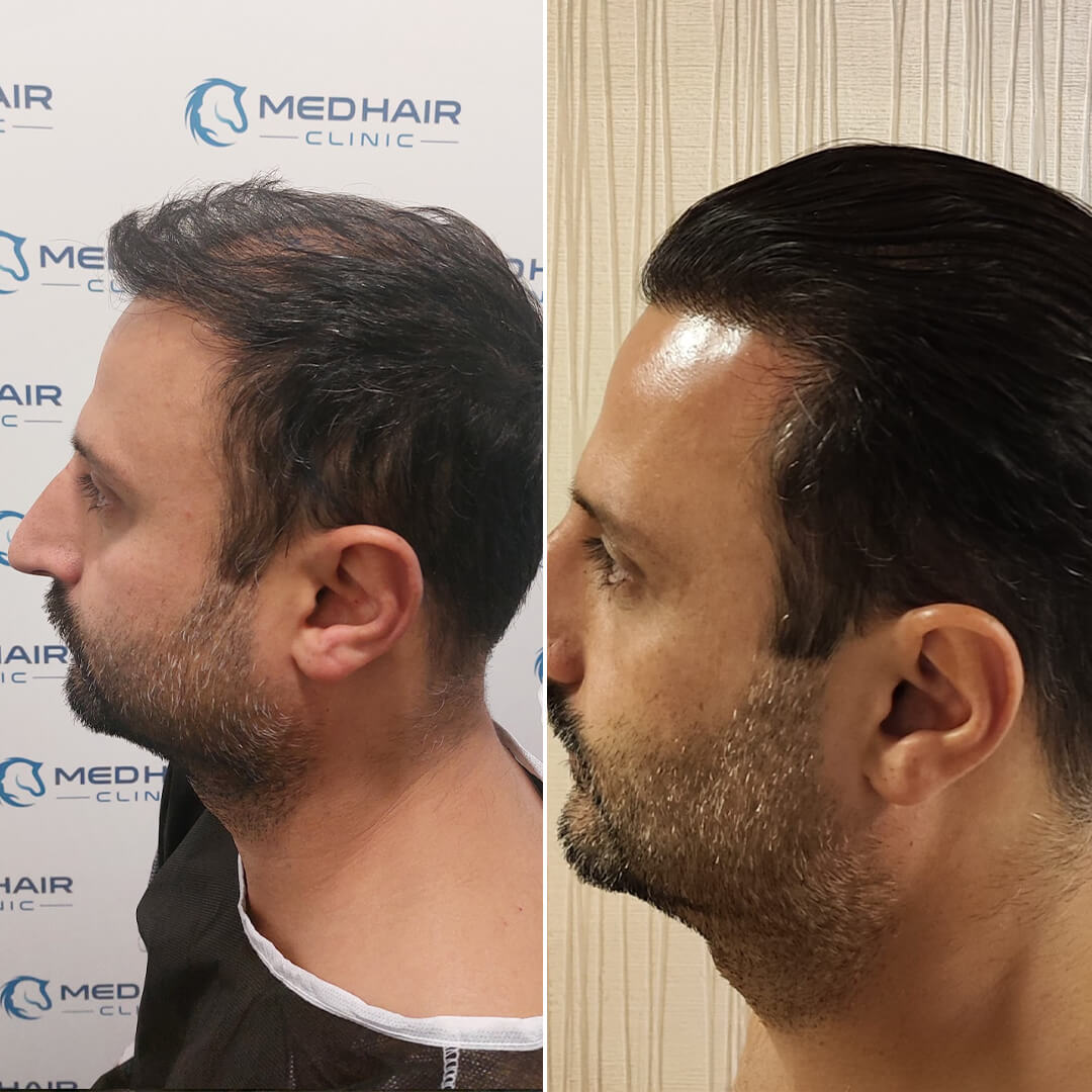 3900 Grafts vorher-nachher Ergebnis mit DHI – gleichmäßige Haarverdichtung und natürliches Aussehen durch präzise Direktimplantation
