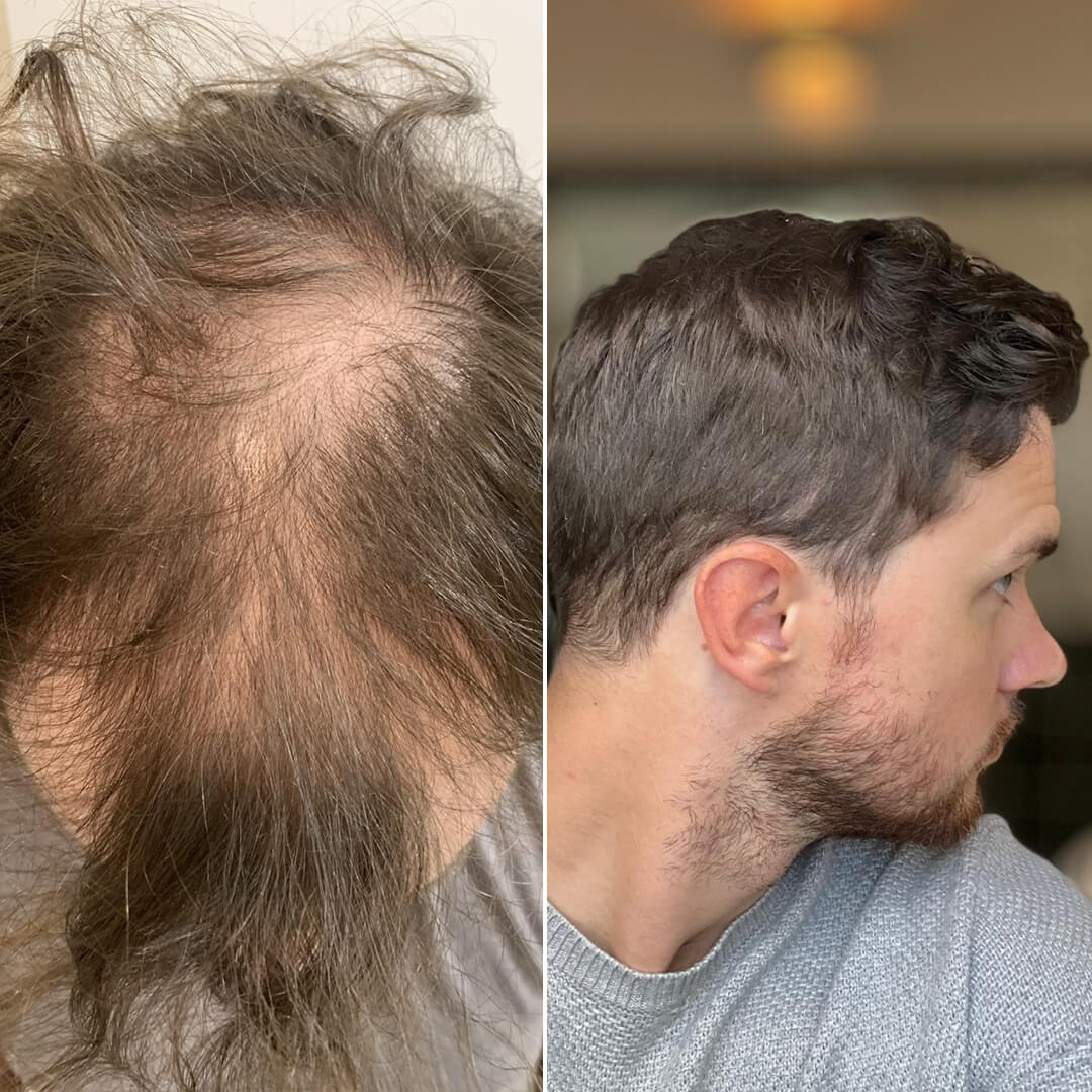 4000 Grafts vorher-nachher mit DHI-Technik – natürliche Haarlinie und hohe Dichte durch direkte Implantation ohne Kanalöffnung