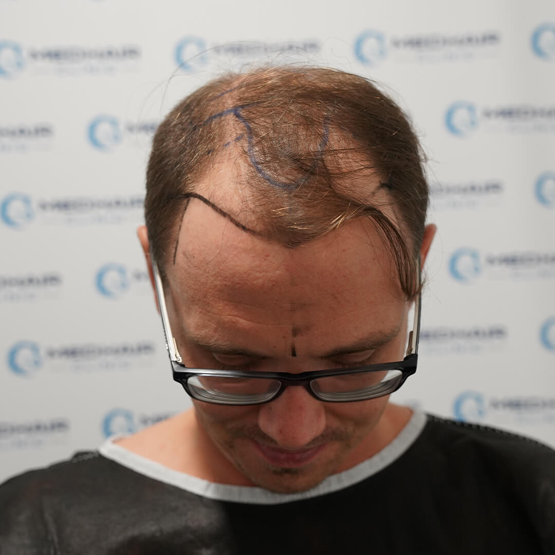 4800 Grafts vor der Haartransplantation – Ausgangszustand bei fortgeschrittenem Haarausfall zur Planung der Eigenhaarverpflanzung
