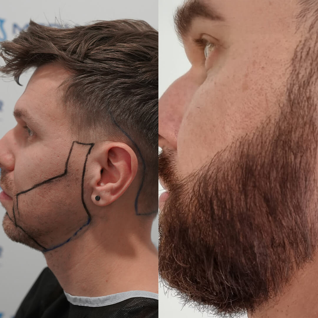 Barthaartransplantation mit 2400 Grafts – Ergebnis zeigt natürlichen Bartwuchs und gleichmäßige Verdichtung im Wangenbereich