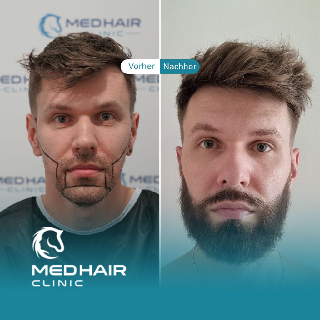 Barttransplantation vorher-nachher Türkei – Ergebnis zeigt volle Bartdichte und gleichmäßiges Wachstum durch FUE-Methode