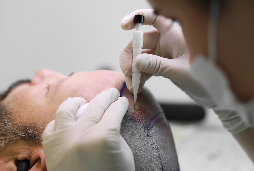 DHI Haartransplantation mit Choi Implanter Pen