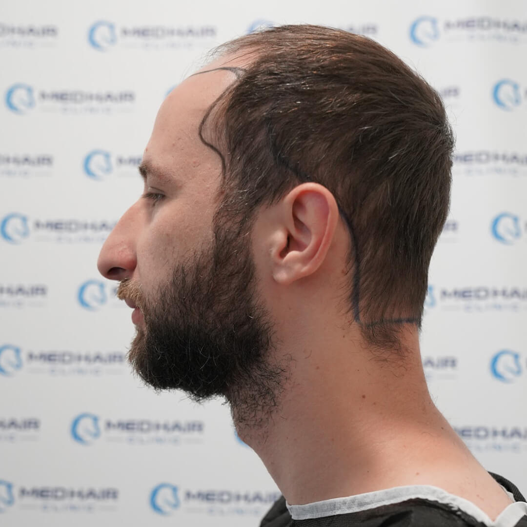DHI Haartransplantation mit 3300 Grafts – schonende Methode für gezielte Haarverdichtung und natürliches Wachstum