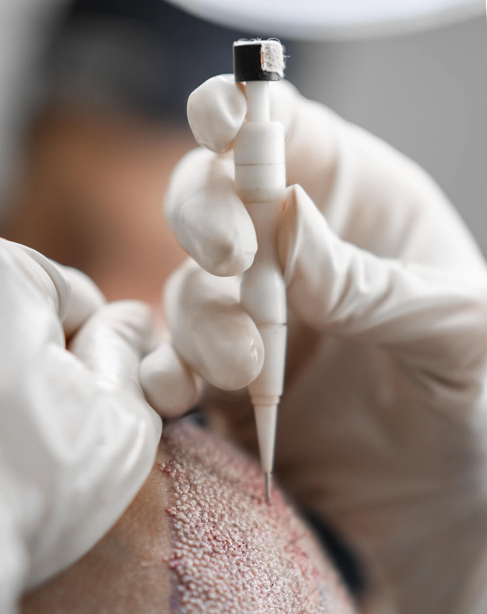 Grafts mit dem DHI Implanter Pen einsetzen