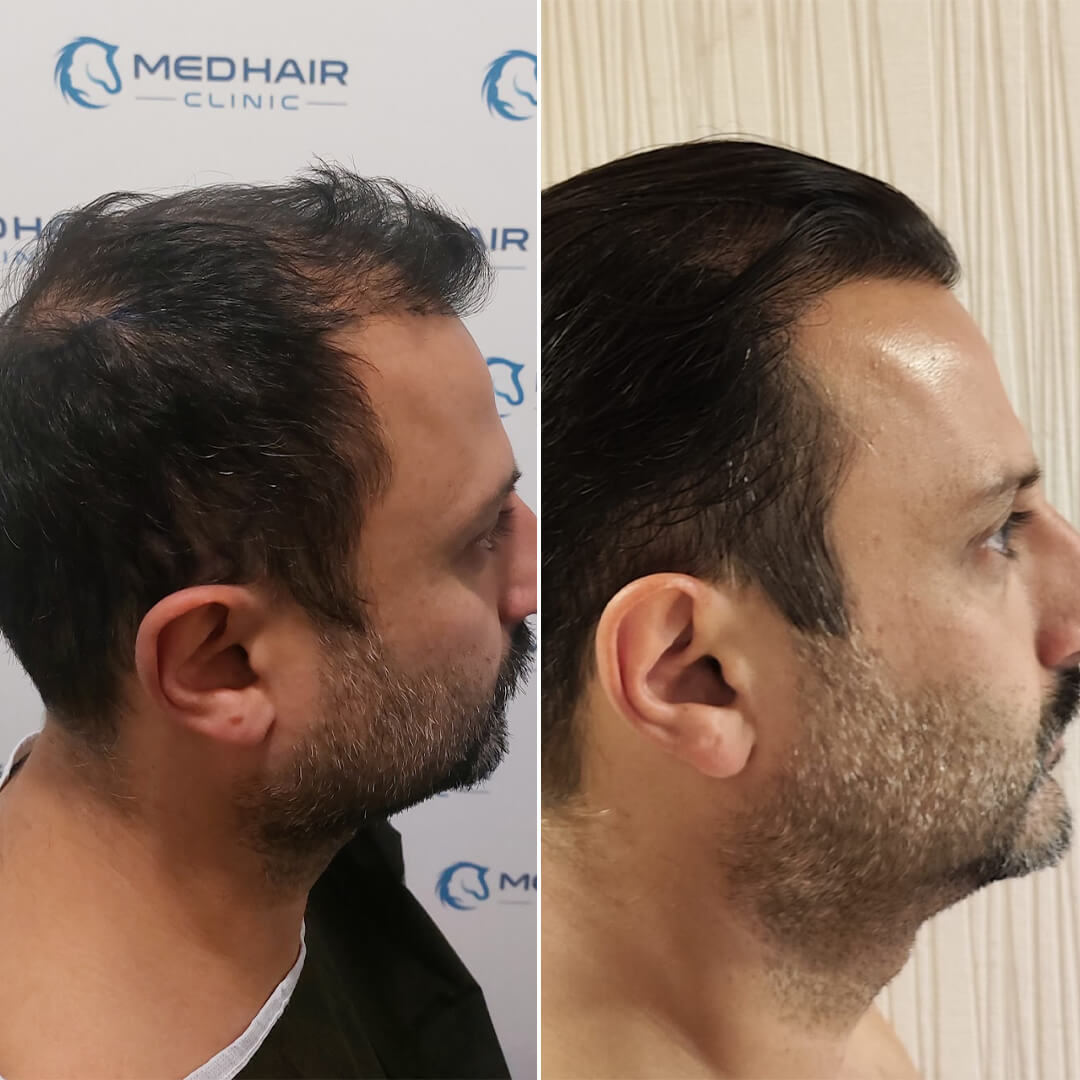 DHI-Technik mit 3900 Grafts – präzise Haartransplantation mit direkter Implantation für dichte und natürlich wirkende Ergebnisse