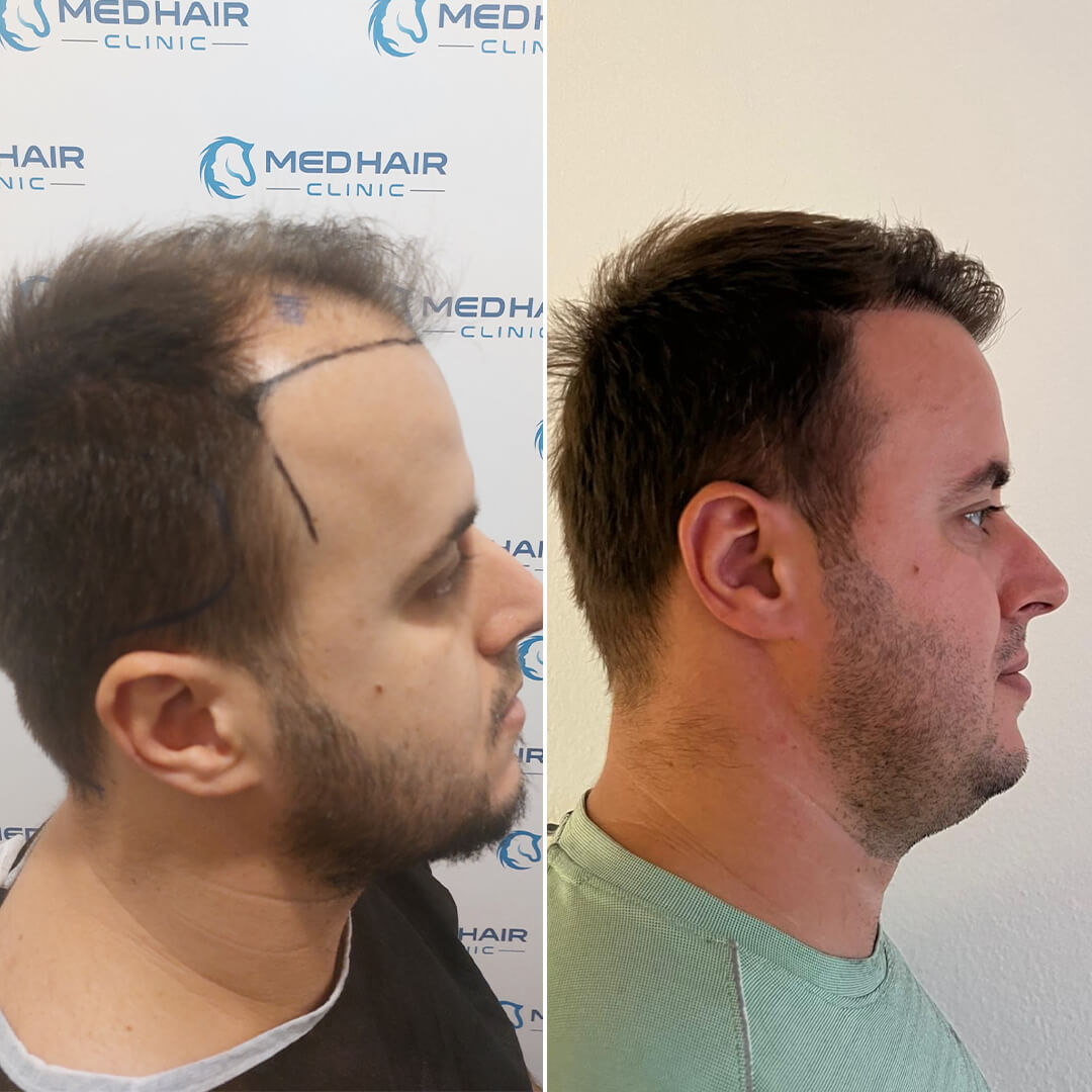 Ergebnis von 2900 Grafts mit DHI-Technik – natürliche Haarverdichtung durch direkte Implantation ohne Kanalöffnung
