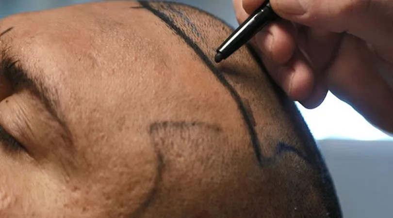 Geschlechtsverkehr nach der Haartransplantation – körperliche Belastung und Schwitzen in den ersten Tagen besser vermeiden