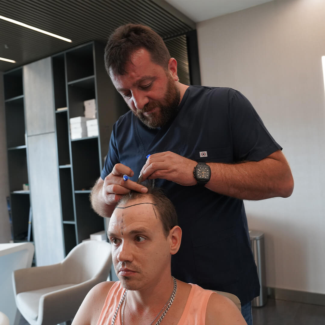 Haaranalyse für 4800 Grafts – präzise Planung der Haartransplantation basierend auf Haardichte, Spenderbereich und Ausfallmuster