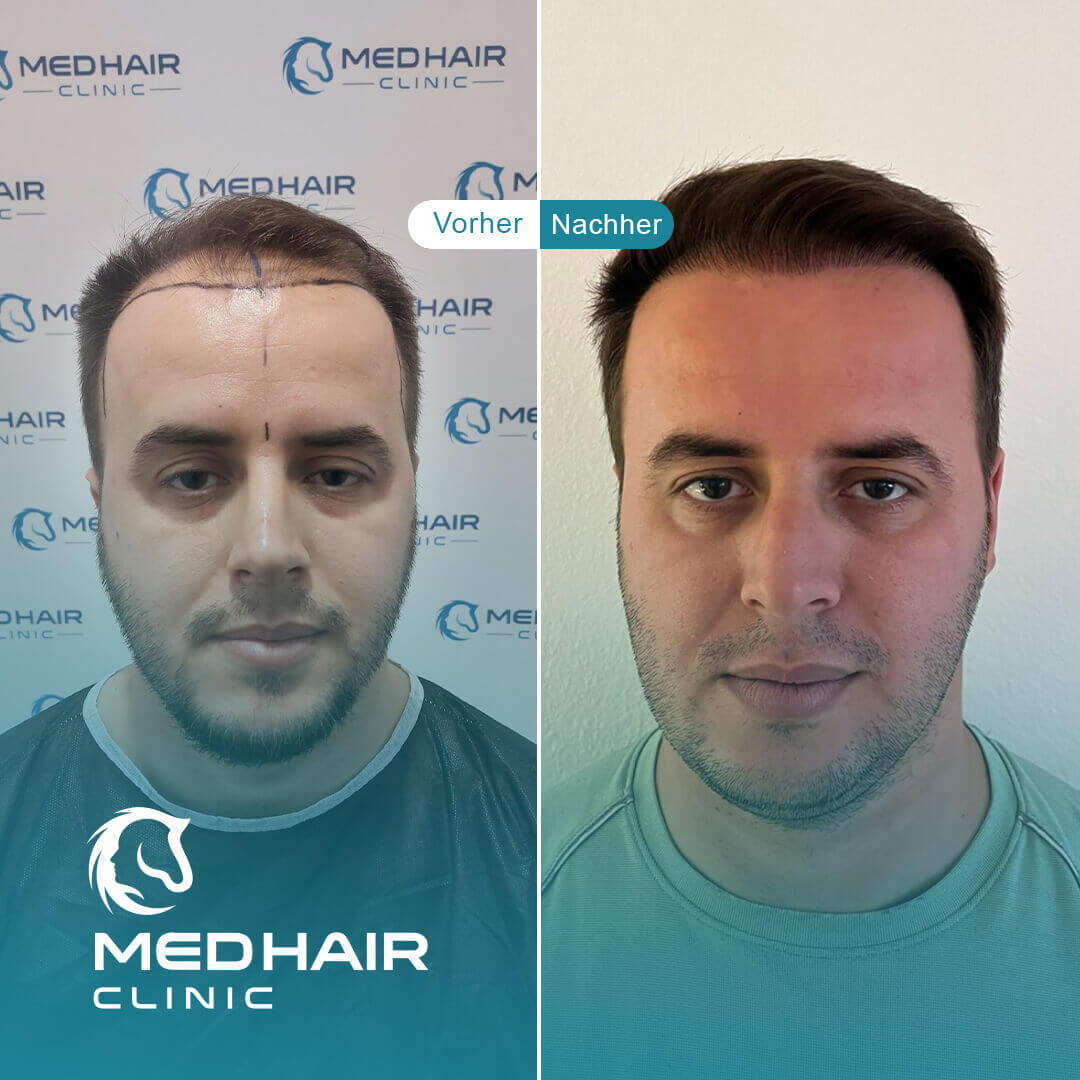 Haartransplantation mit 2900 Grafts vorher-nachher – gezielte Verdichtung bei Geheimratsecken für natürliches Aussehen
