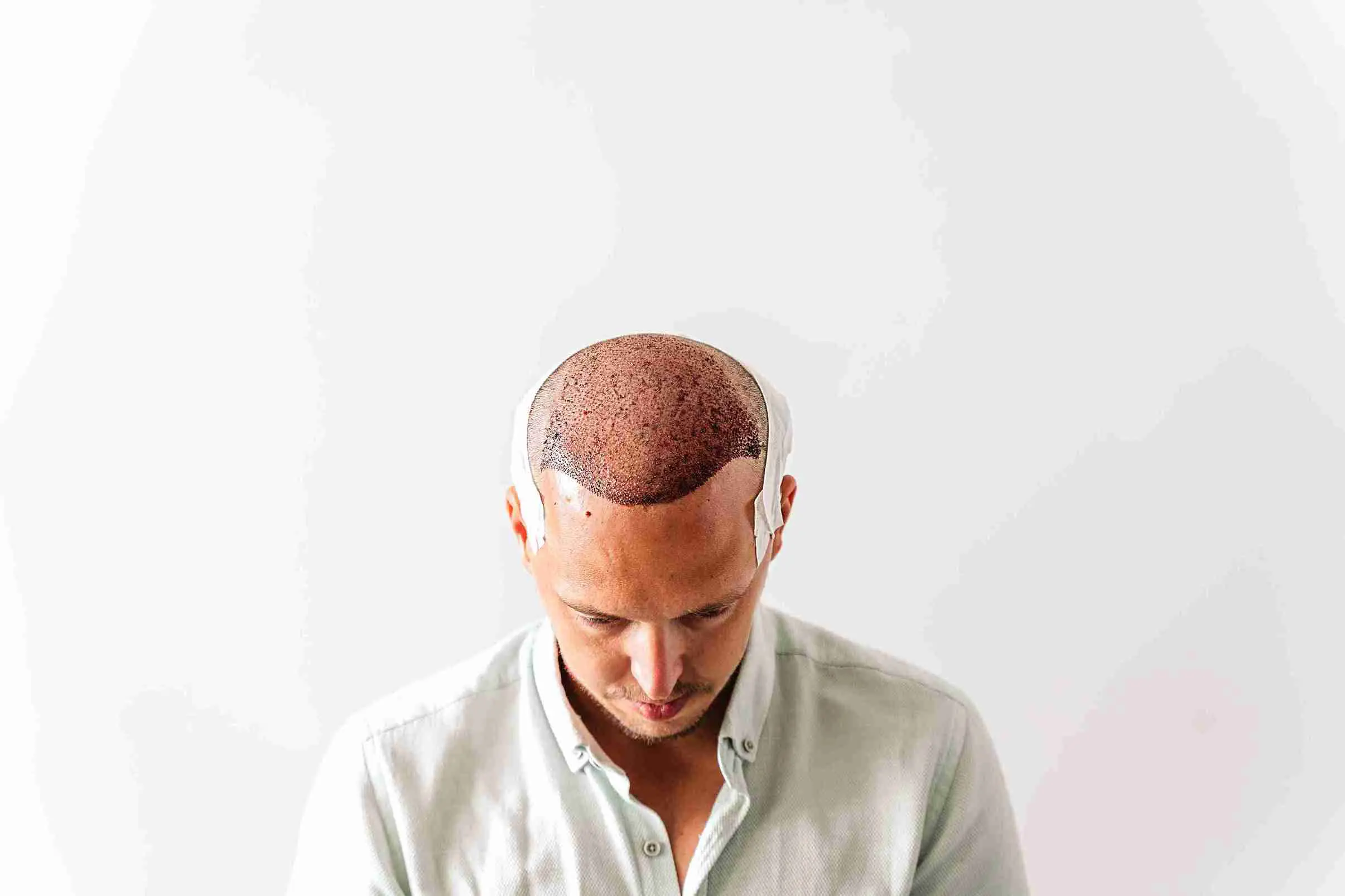 Mann nach einer Haartransplantation mit sichtbaren Spuren am Kopf – typisches Bild direkt nach dem Eingriff zum Thema Haartransplantation Schmerzen.