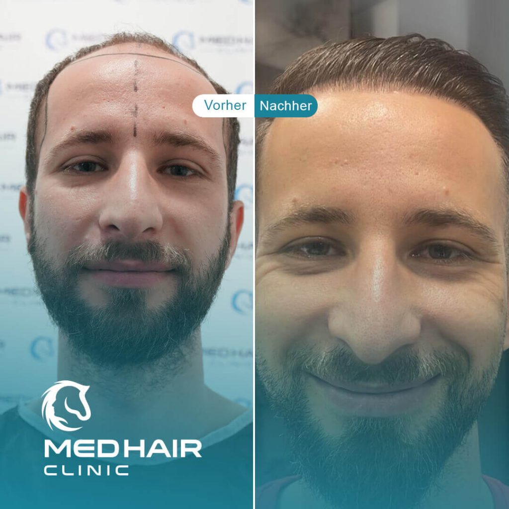 Haartransplantation Türkei vorher-nachher mit 3300 Grafts – natürliche Verdichtung der Haarlinie und sichtbare Ergebnisse