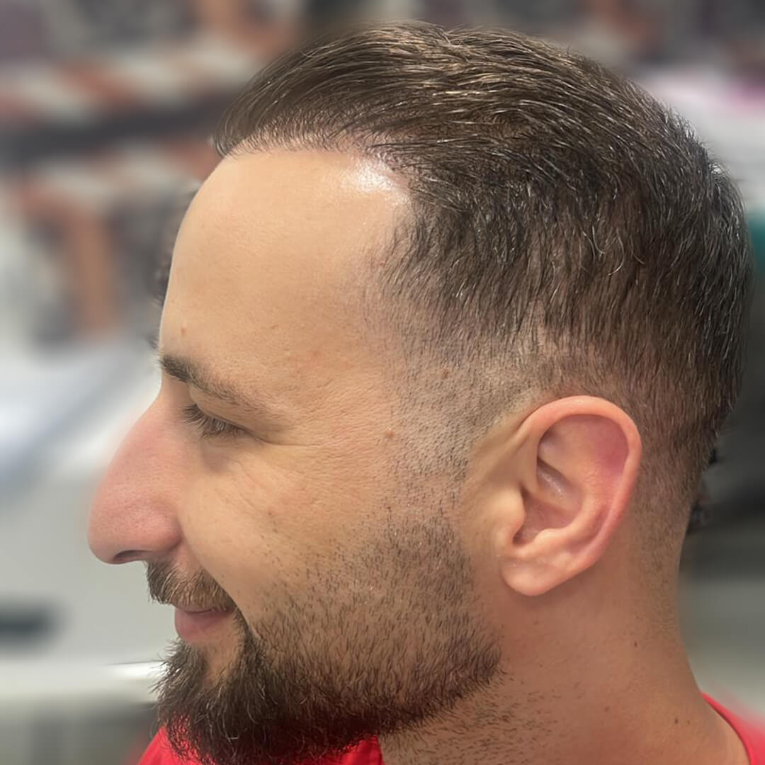 Haartransplantation Türkei vorher-nachher mit 3300 Grafts – natürliche Verdichtung bei Geheimratsecken und Stirnhaarlinie