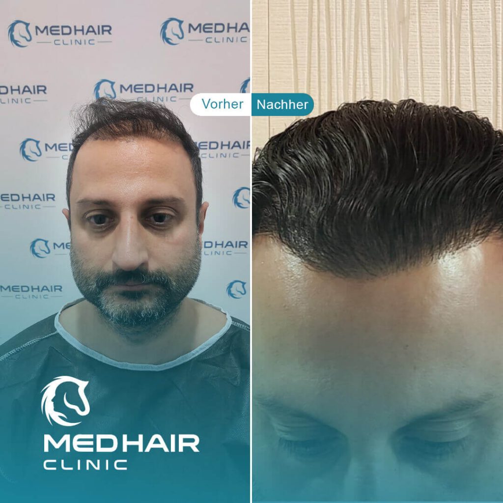 Haartransplantation vorher-nachher mit 3900 Grafts – sichtbare Verbesserung bei Haarausfall im Stirn- und Tonsurbereich