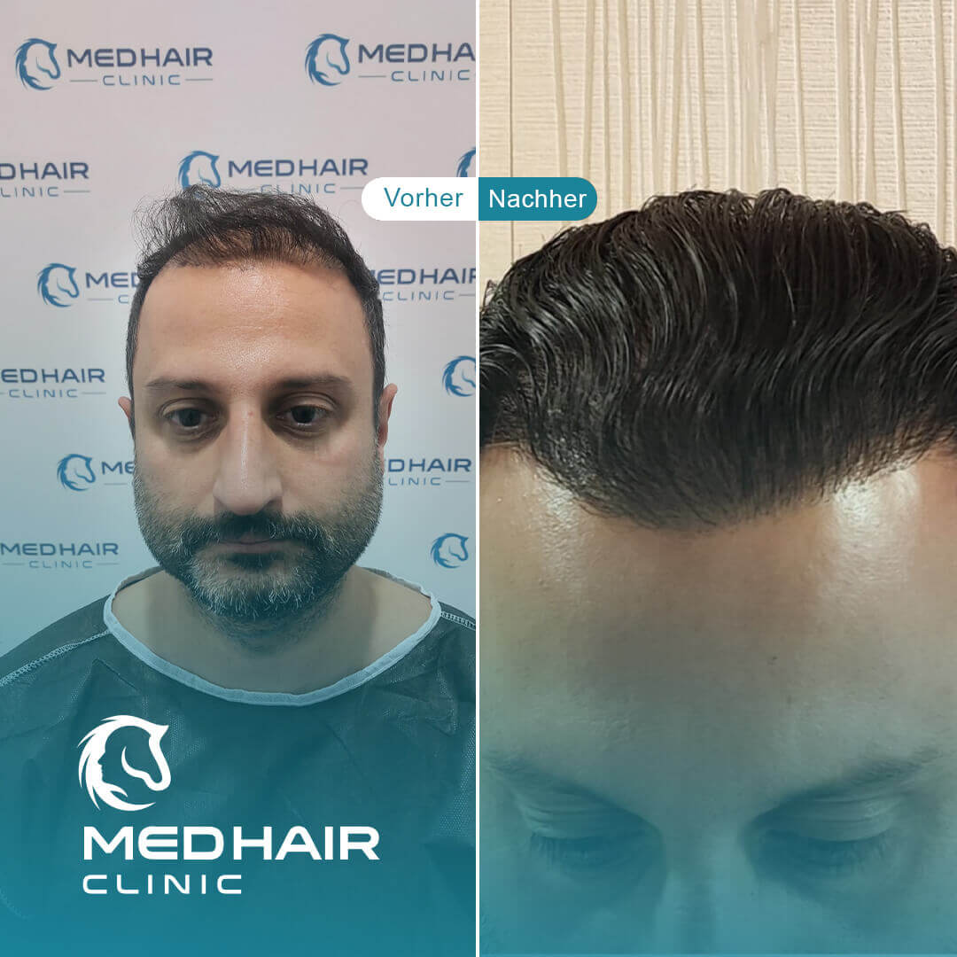 Haartransplantation vorher-nachher mit 3900 Grafts – sichtbare Verbesserung bei Haarausfall im Stirn- und Tonsurbereich