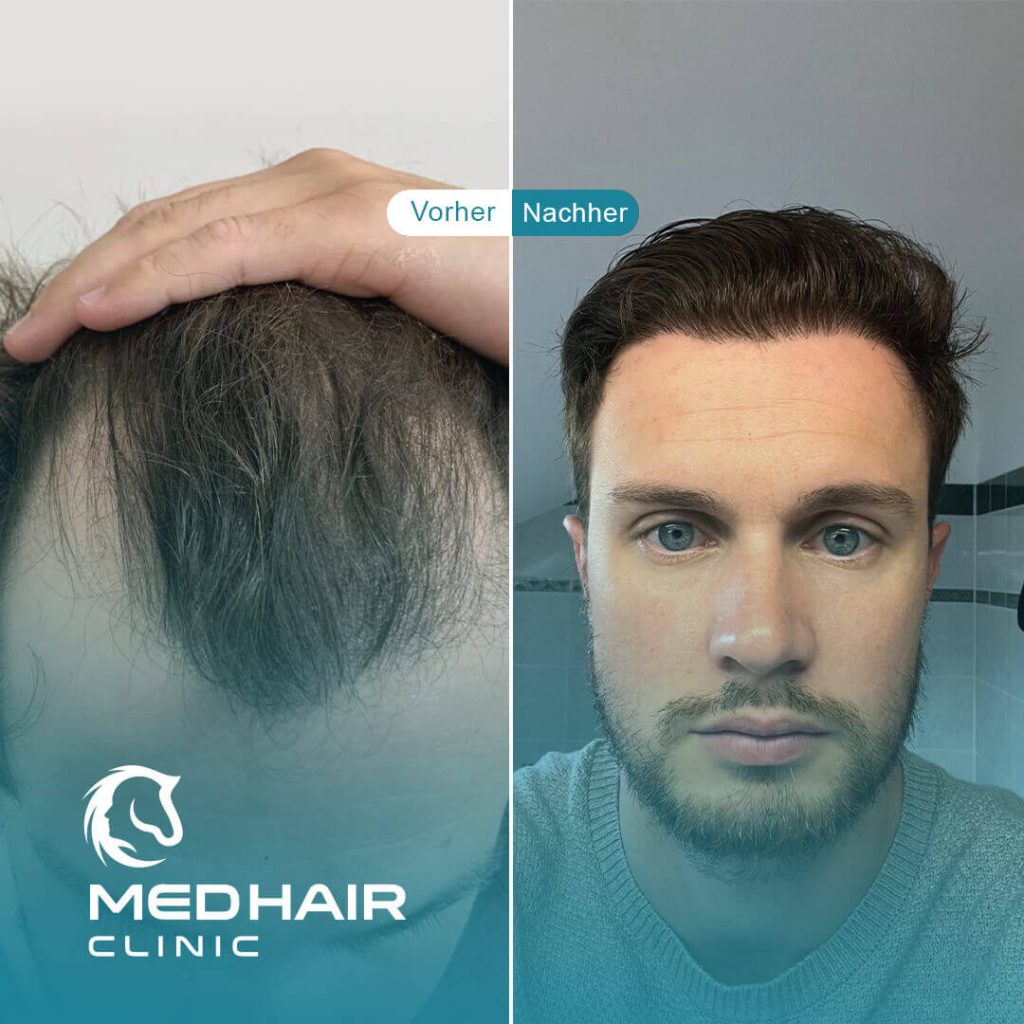 Haartransplantation vorher-nachher mit 4000 Grafts – deutliche Verdichtung am Oberkopf und natürlich wirkender Haaransatz