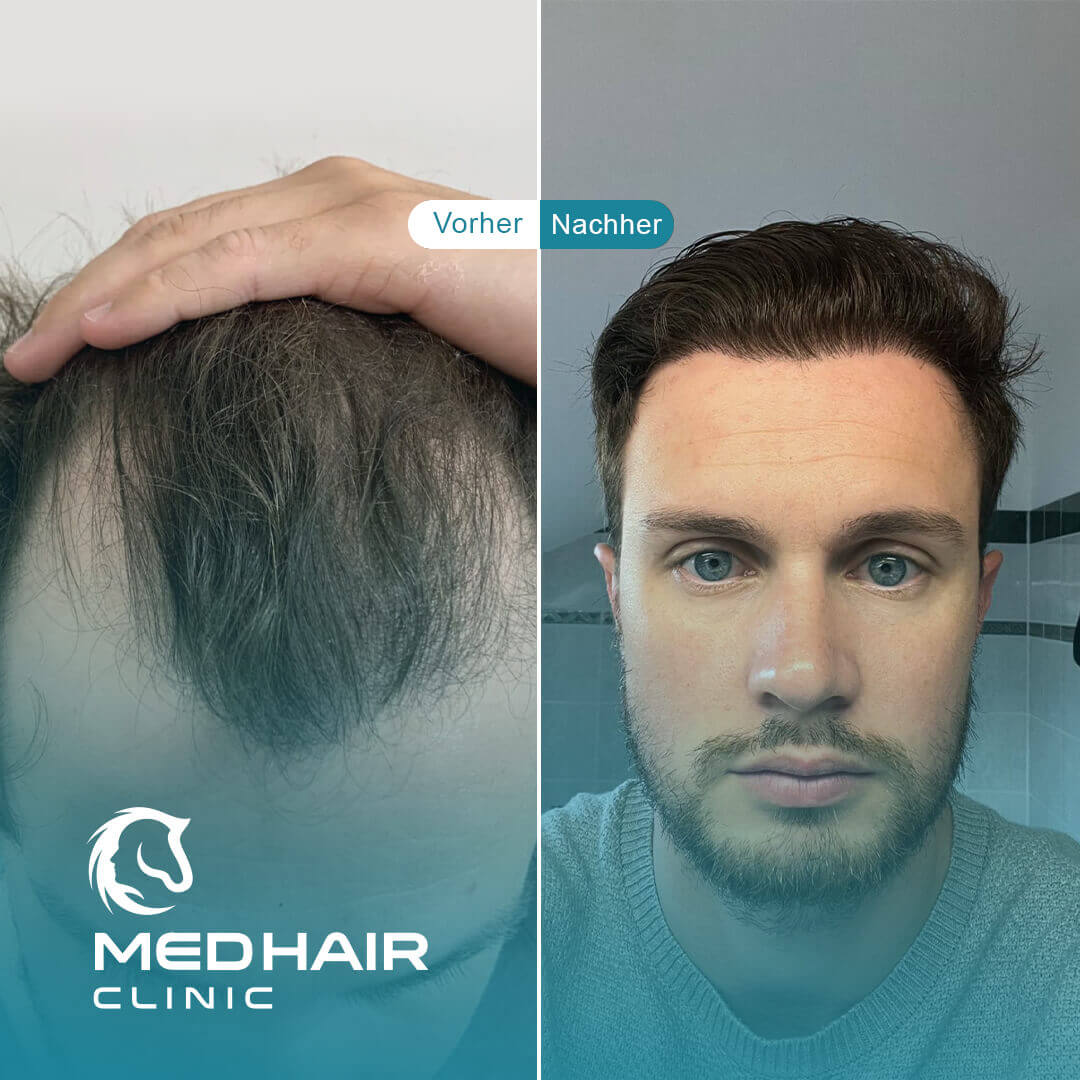 Haartransplantation vorher-nachher mit 4000 Grafts – deutliche Verdichtung am Oberkopf und natürlich wirkender Haaransatz