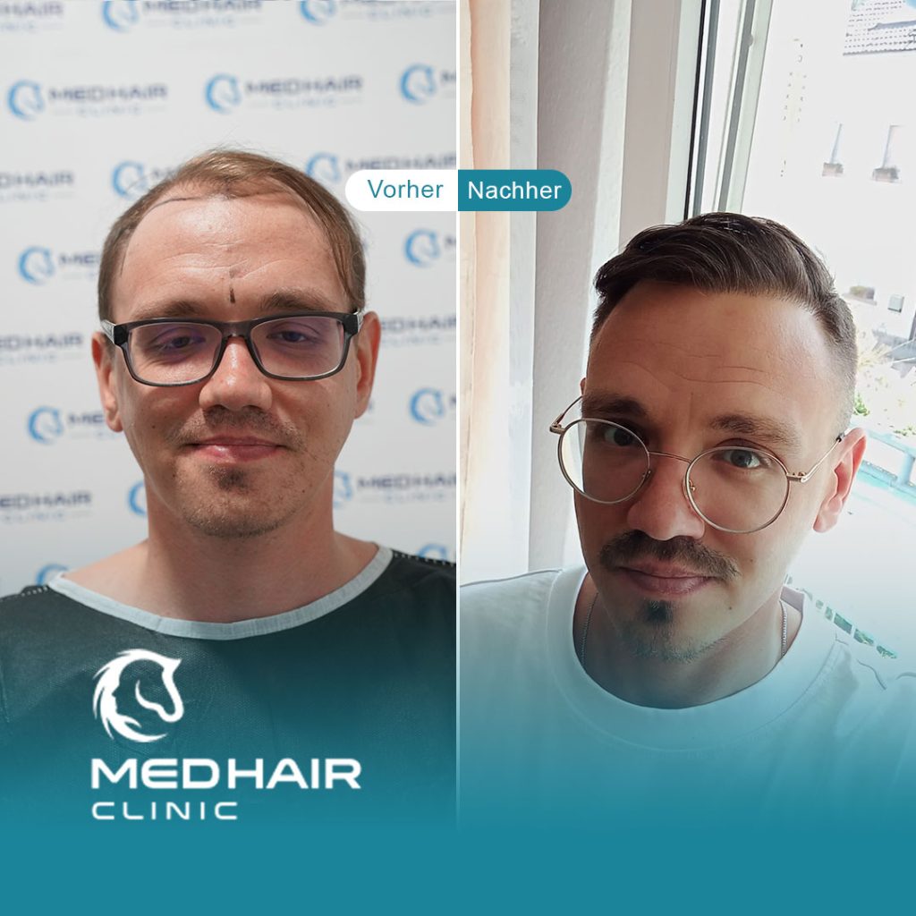 Haartransplantation vorher-nachher mit 4800 Grafts – sichtbare Veränderung bei Geheimratsecken und lichter Haarlinie