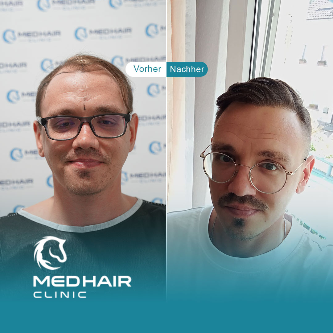 Haartransplantation vorher-nachher mit 4800 Grafts – sichtbare Veränderung bei Geheimratsecken und lichter Haarlinie