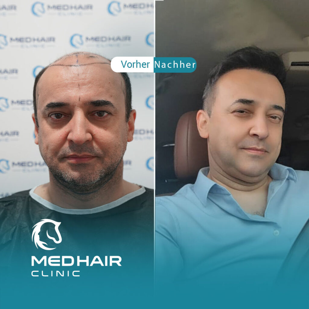 Haartransplantation mit 5000 Grafts zum Traumergebnis
