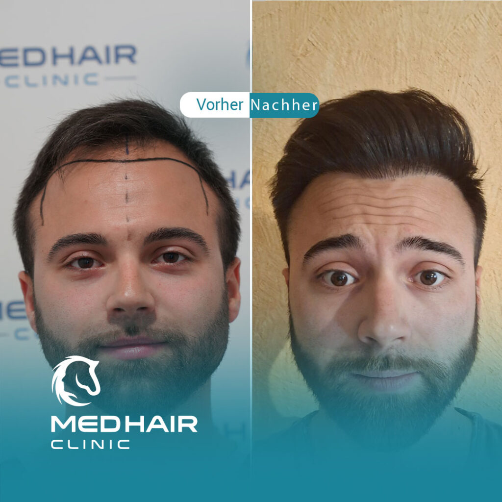 Vorher Nachher Ergebnis einer Haarverpflanzung