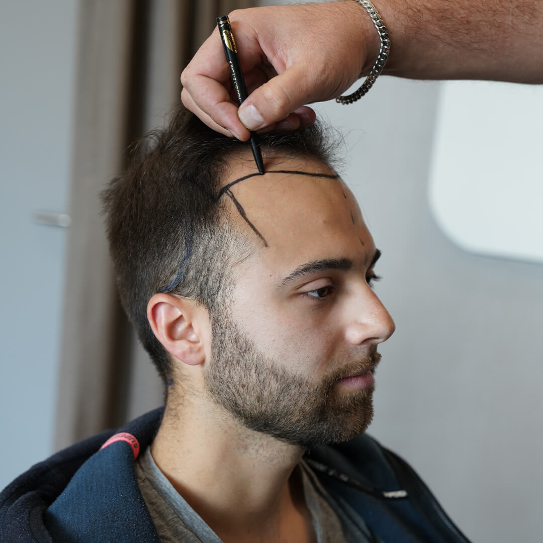 Haarverpflanzung mit 3100 Grafts – gezielte Eigenhaartransplantation für natürliche Haardichte und gleichmäßigen Haaransatz