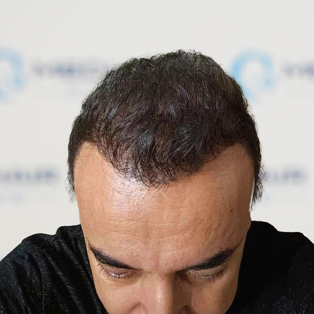Saphir Haartransplantation mit 5000 Grafts – dichte Ergebnisse durch präzise Kanaltechnik und minimalinvasiven Eingriff