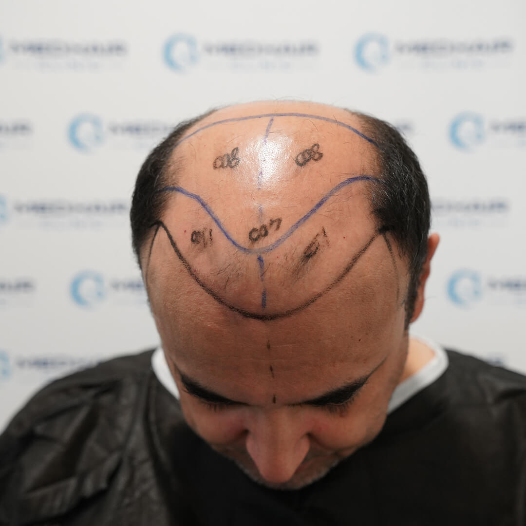 Saphir Haartransplantation mit 5000 Grafts – maximale Haardichte durch präzise Kanalöffnung mit feiner Saphirklinge