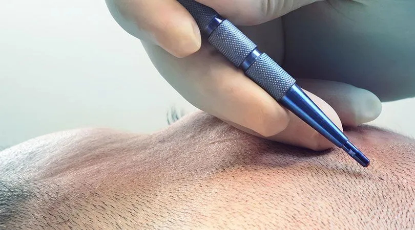 Saphir Haartransplantation – moderne Methode mit Saphirklinge für präzisere Einschnitte und schnellere Heilung