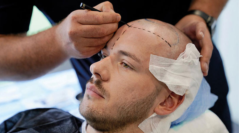 Wann die Schwellung nach einer Haartransplantation zurückgeht – meist innerhalb von 3–5 Tagen durch Kühlung und Kopfhochlagern