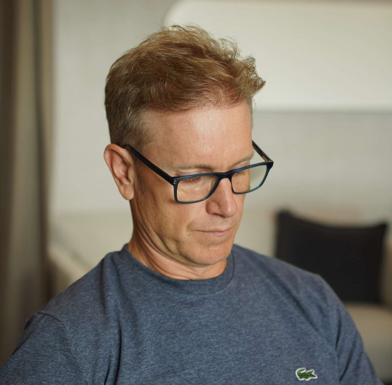 Haartransplantation vorher nachher türkei 3200 Grafts