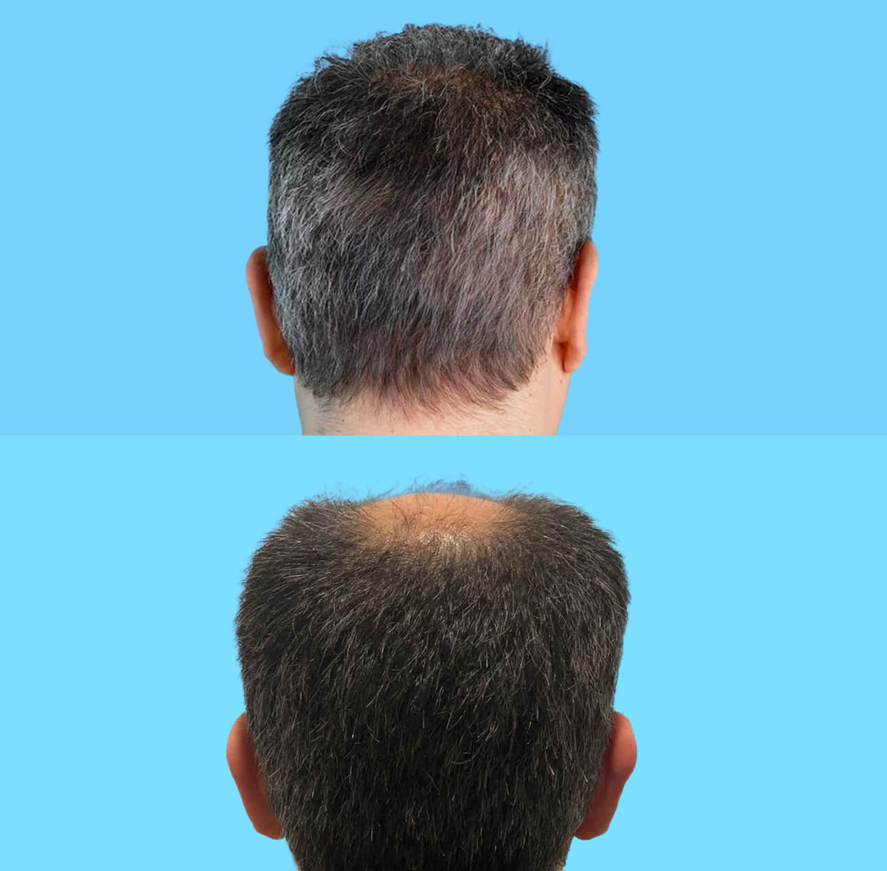 Haartransplantation vorher nachher Tonsur 3400 Grafts