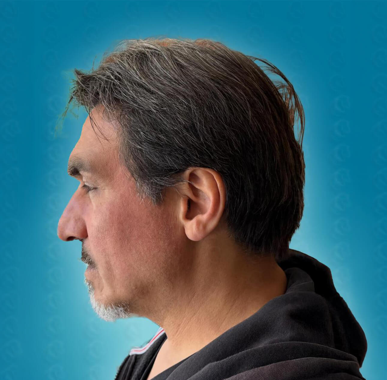 Natürliches Haartransplantation Ergebnis mit 3500 Grafts