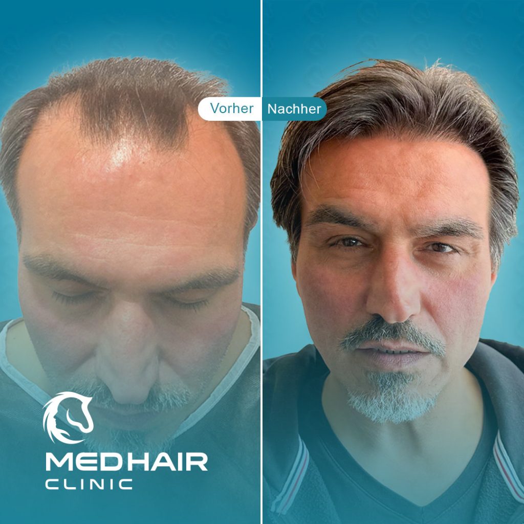Haartransplantation 3500 Grafts vorher nachher – sichtbare Verdichtung