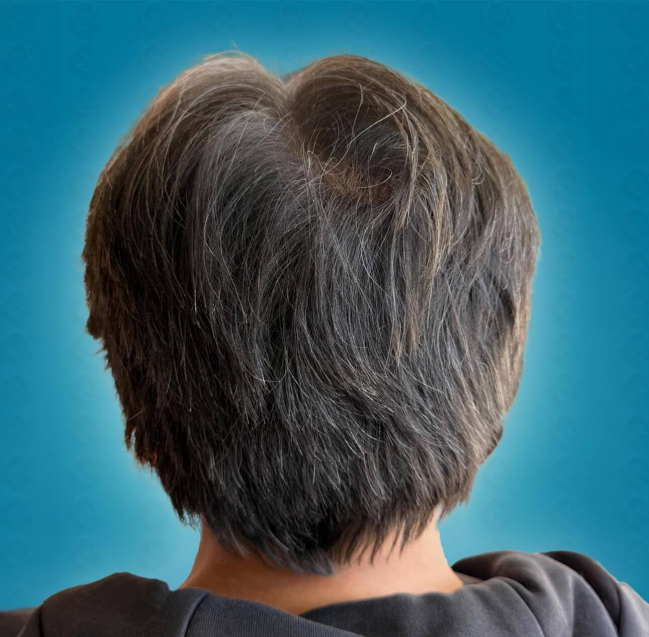 Spenderbereich vorher nachher nach Haartransplantation mit 3500 Grafts