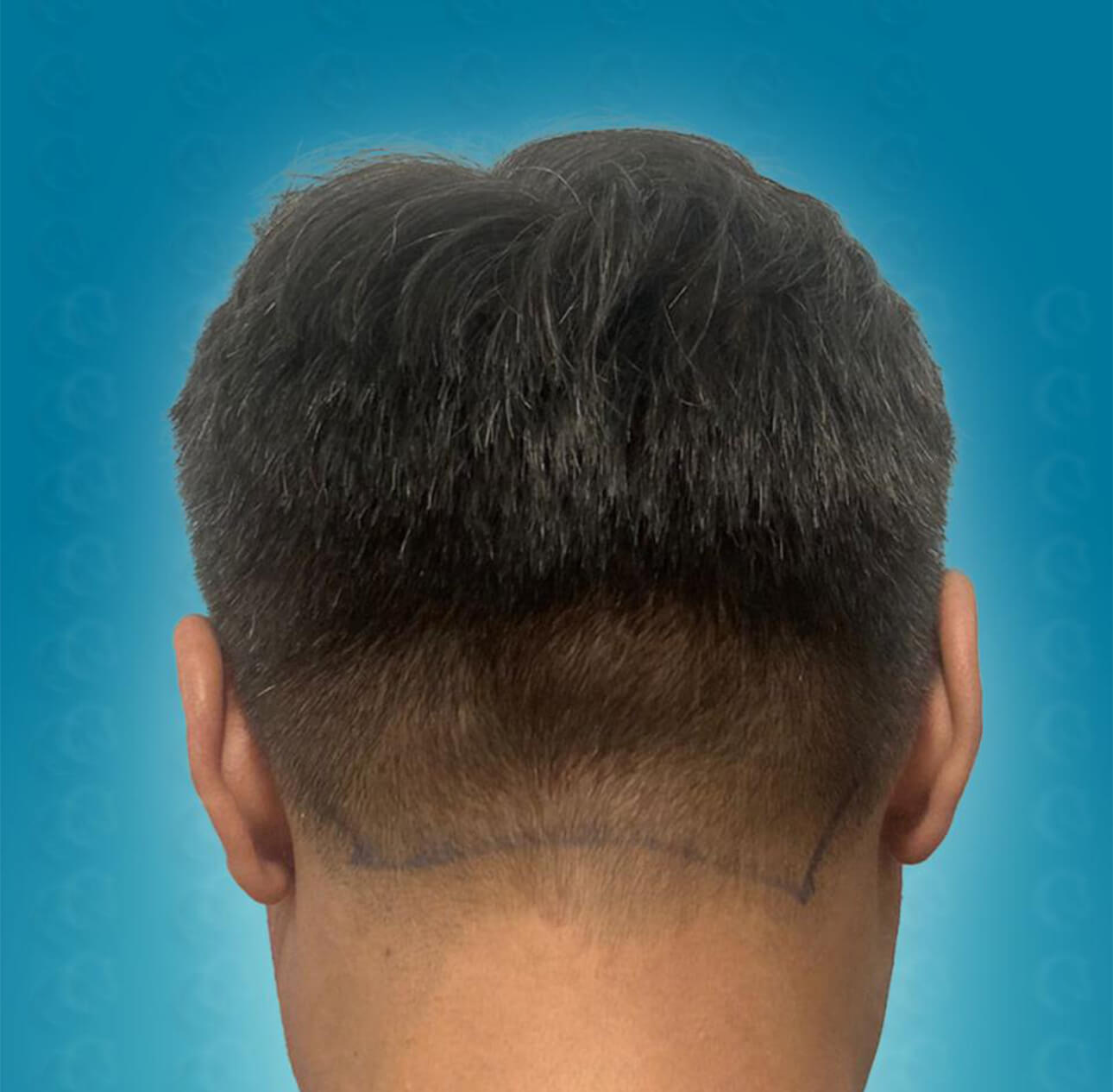 Spenderbereich vor der Haartransplantation mit 3500 Grafts