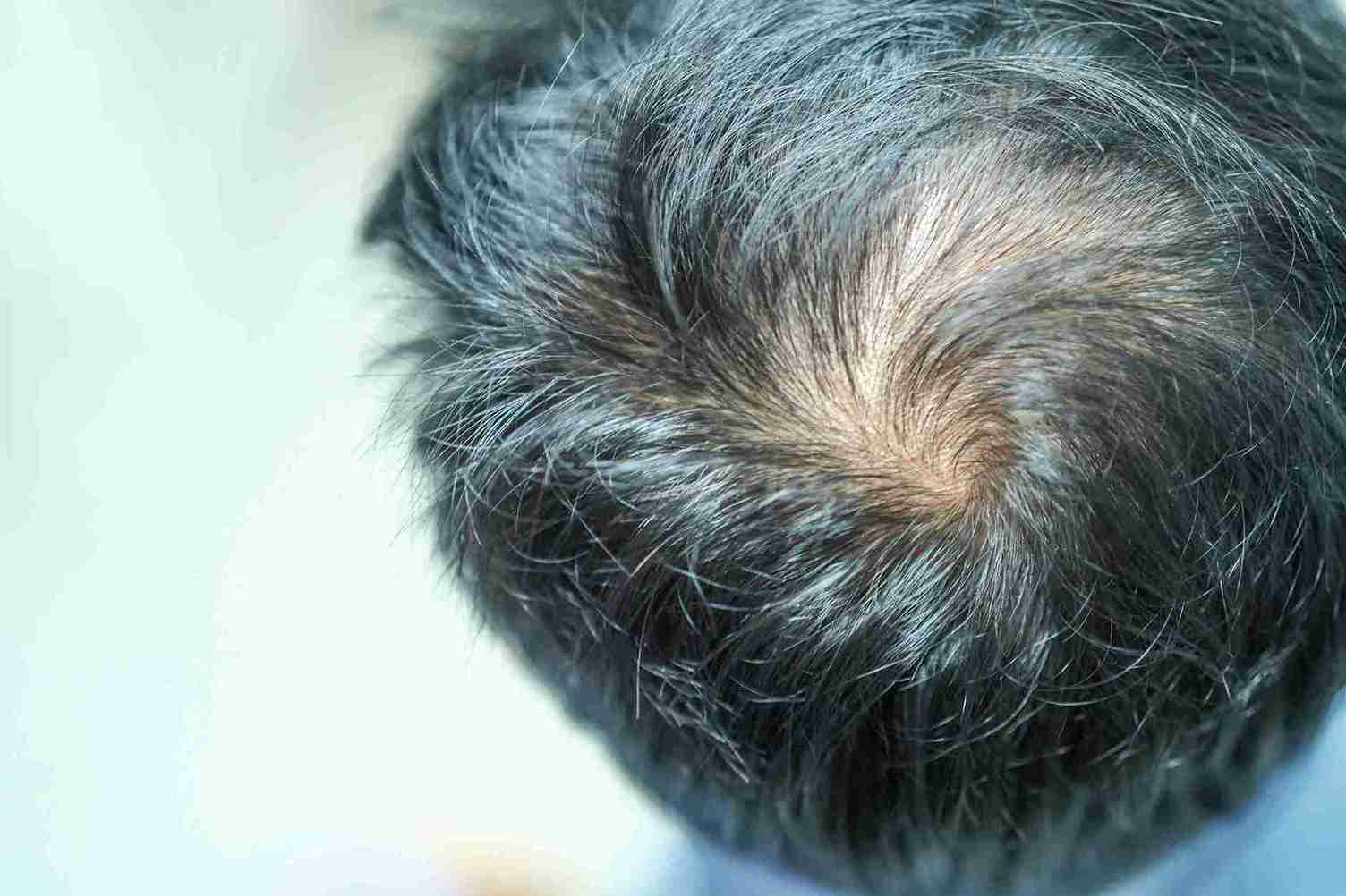 Dünner werdendes Haar am Hinterkopf einer Person, sichtbar aus der Vogelperspektive, als Symbol für Haare stärken und Haargesundheit.