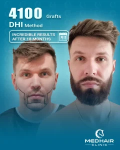 Vorher-Nachher Bild einer Barttransplantation mit 4100 Grafts