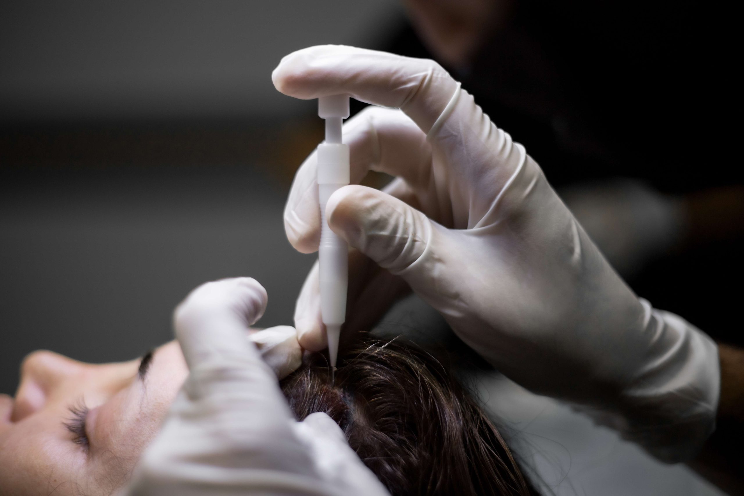 Frau bekommt eine Haartransplantation mit der DHI Saphir Haartransplantation. Ohne Rasur der Haare.