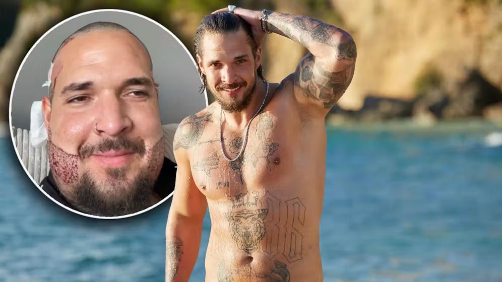 Haartransplantation in der Türkei bei Zico Banach