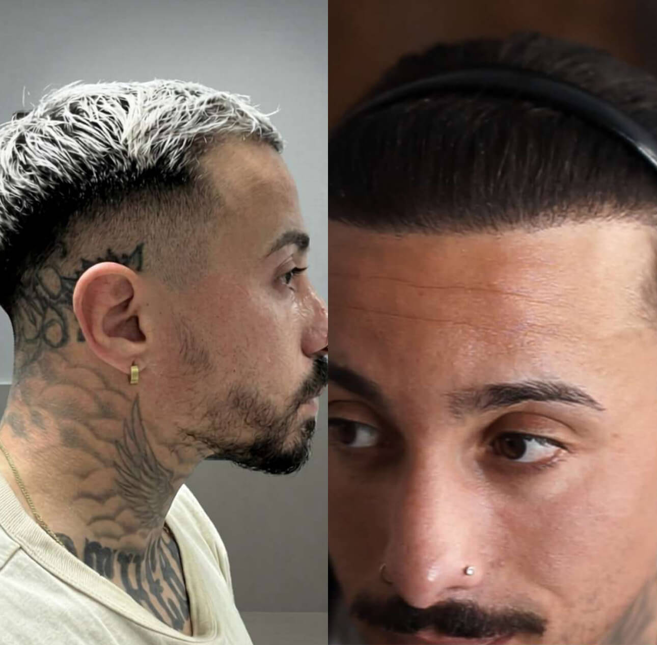 2600 Grafts Haartransplantation vorher nachher Ergebnis mit natürlicher Haarlinie