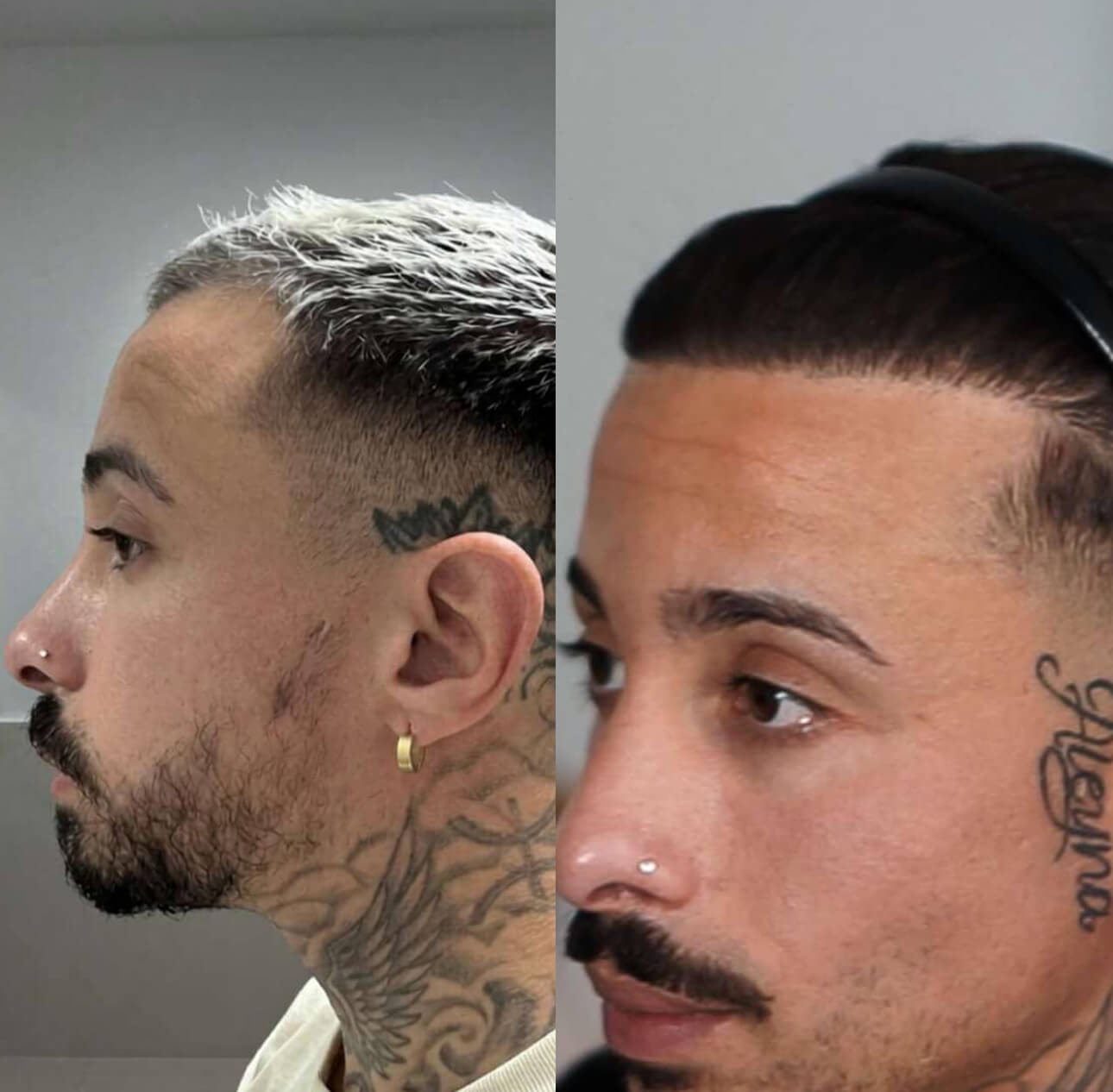 Haartransplantation Türkei vorher nachher 2600 Grafts Ergebnis natürliche Haarlinie