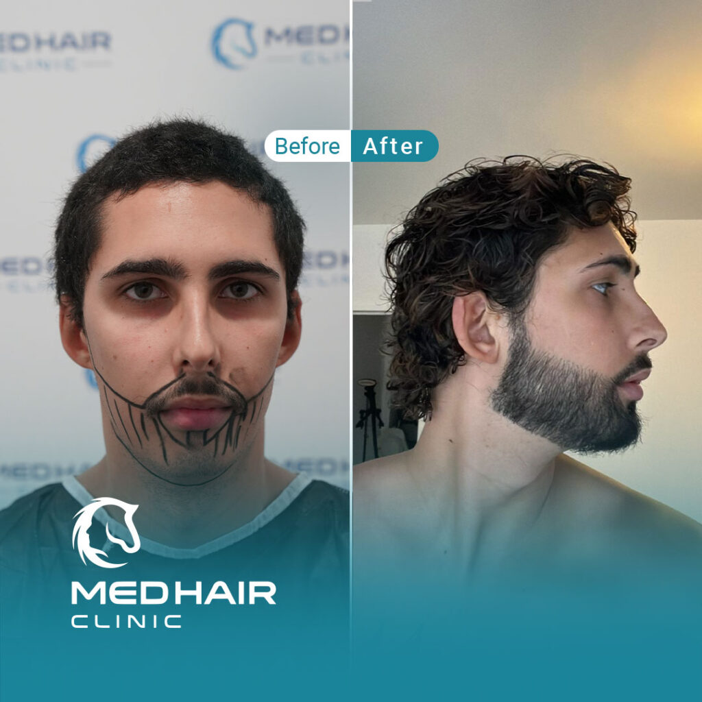 Before and after beard transplant in Turkey at MedHair Clinic Istanbul showing natural facial hair restoration results