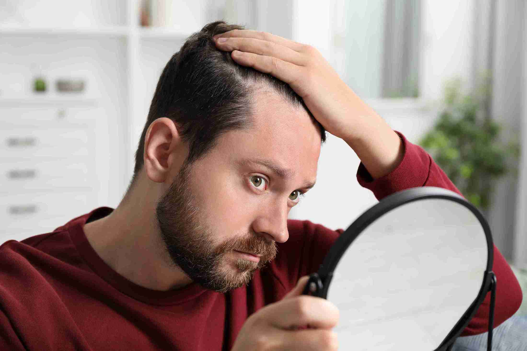 A man with a beard holding a mirror and examining his receding hairline while pushing back his hair with one hand.