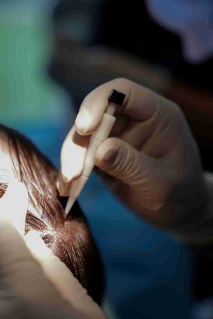 Close-up of a gloved hand performing a hair transplant without shaving, using a precision implant tool to insert hair follicles into the patient’s scalp while preserving existing hair.