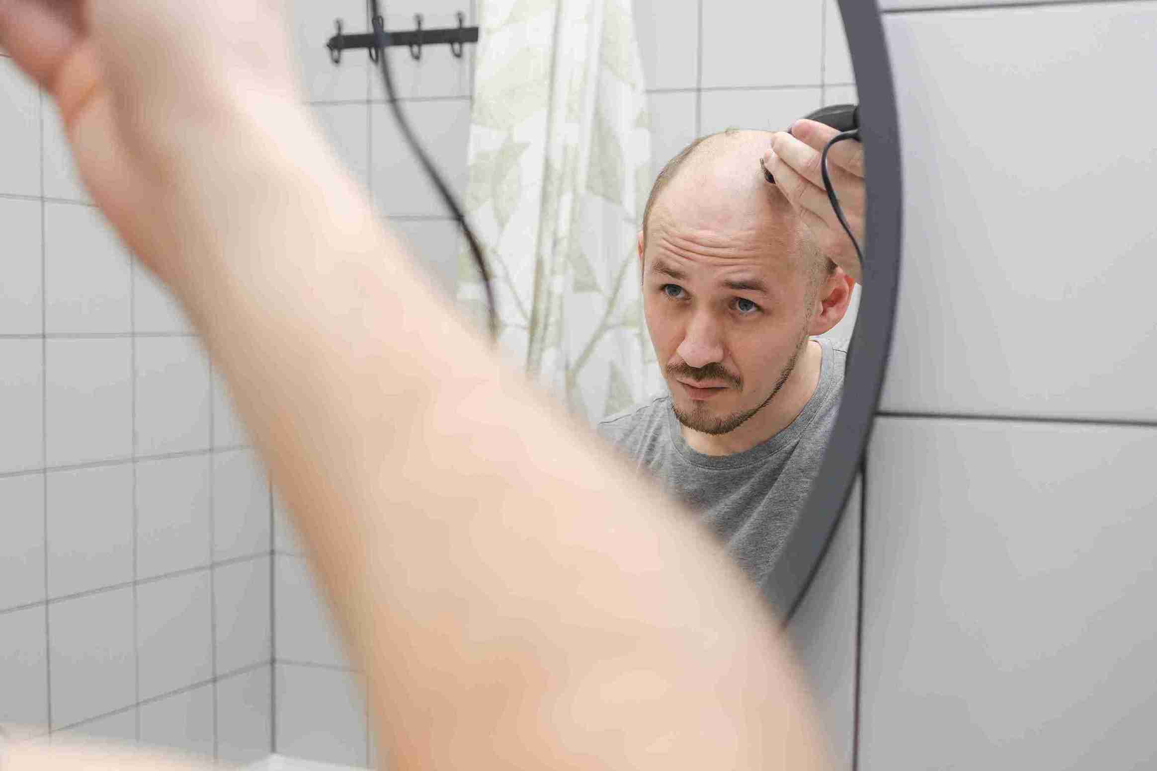 Man looking in the mirror while shaving his balding head, showing advanced hair loss stage on the Norwood Hamilton Scale.