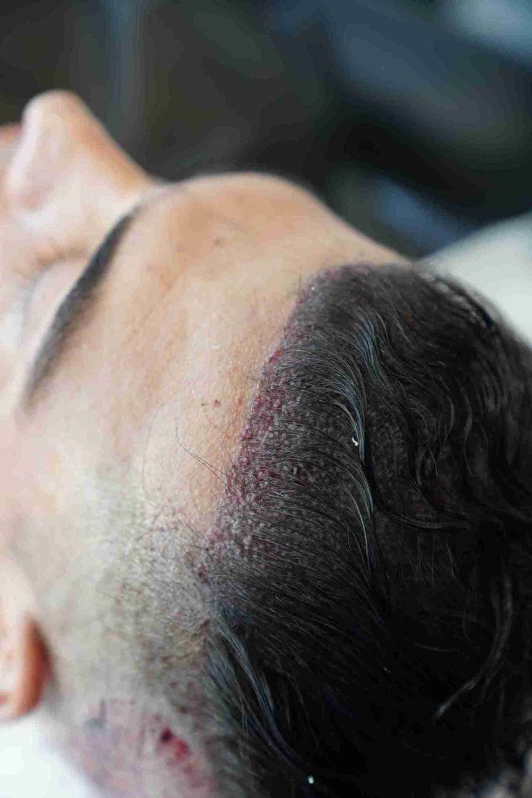 Close-up view of a person’s scalp after a long hair transplant procedure, showing freshly implanted hair follicles with visible redness and tiny scabs