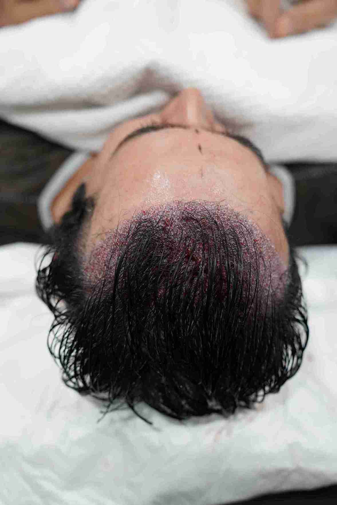 Close-up view of a person’s scalp after a long hair transplant procedure, showing freshly implanted hair follicles with visible redness and tiny scabs
